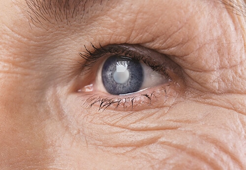 Closeup of a Cataract