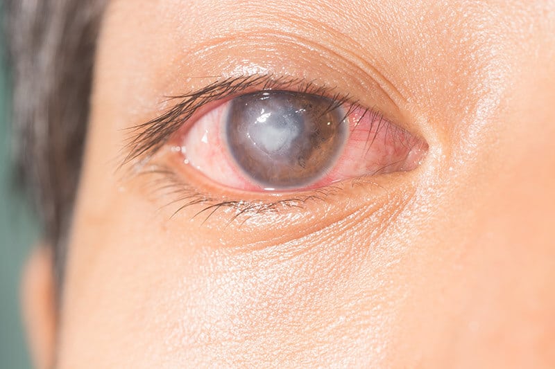 Closeup of an Eye With a Corneal Ulcer