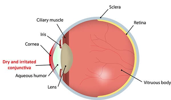 Chart Illustrating Dry Eye