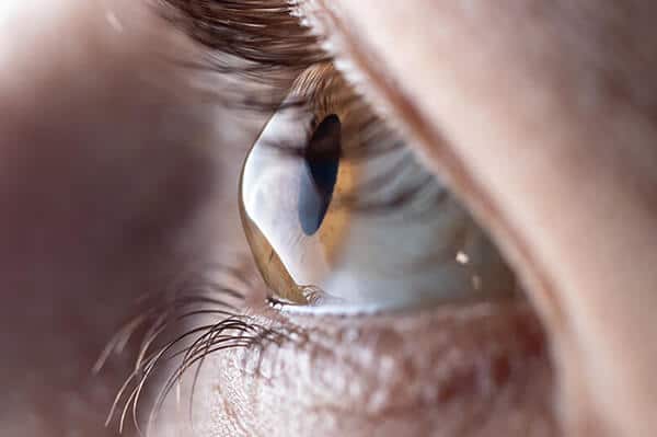 An Eye With Keratoconus