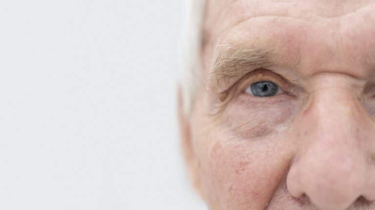 What Is Keratoconus and How Can Crosslinking Help